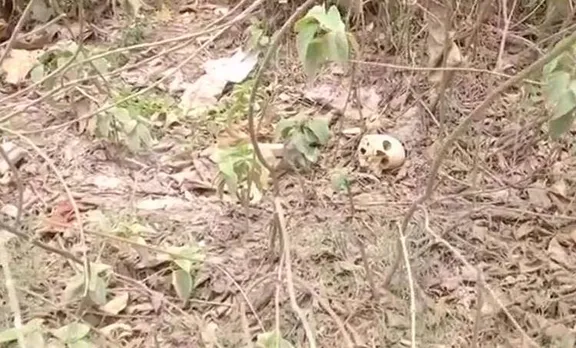 Skeletons, അസ്ഥികൂടങ്ങൾ, Bihar hospital, ബിഹാറിലെ ആശുപത്രി, encephalitis, മസ്തിഷ്കവീക്കം, മസ്തിഷ്ക ജ്വരം, iemalayalam,ഐഇ മലയാളം