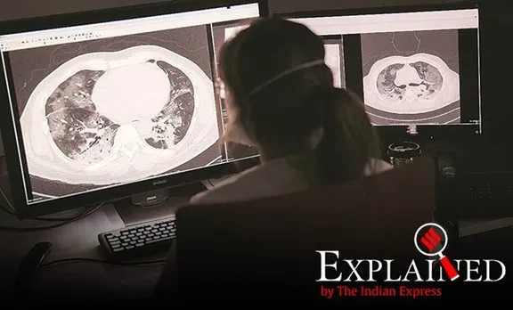 Explained: എങ്ങനെ കൊറോണ വൈറസ് ശ്വാസകോശത്തിൽ പ്രവേശിക്കുകയും ശ്വസനത്തെ ബാധിക്കുകയും ചെയ്യുന്നു