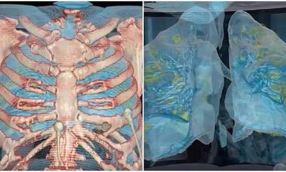 coronavirus lungs, ie malayalam