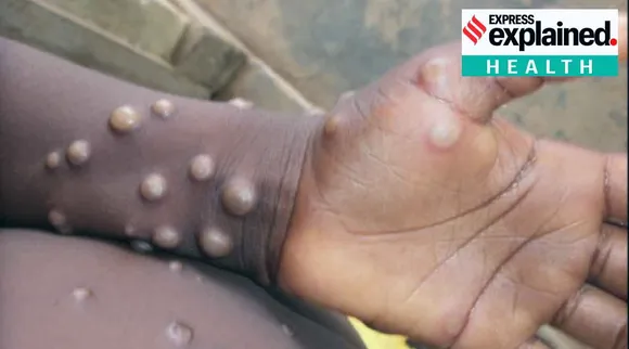 Monkeypox vs smallpox, Monkeypox symptoms, Monkeypox kerala, Monkeypox spread, Monkeypox virus, Monkeypox treatment, Monkeypox malayalam, Monkeypox symptoms malayalam, Monkeypox vaccine, കുരങ്ങ് പനി, കുരങ്ങ് പനി ലക്ഷണങ്ങള്‍, കുരങ്ങ് വസൂരി, കുരങ്ങ് പനിയുടെ ലക്ഷണം, കുരങ്ങ് പനി ചികിത്സ