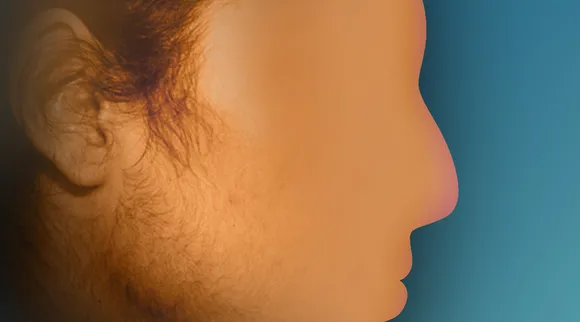 facial hair, facial hair removal, facial hair removal home remedy