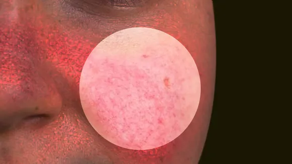 redness on face, how to treat redness on the face, natural remedies to heal redness on the face