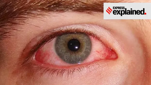 eye infection|conjuctivitis| health