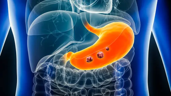 stomach cancer