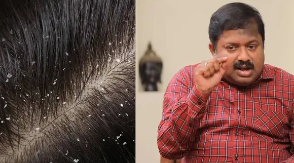 Sivaraman and dandruff