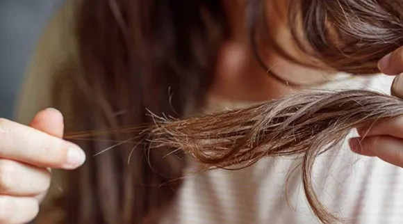 Hairloss