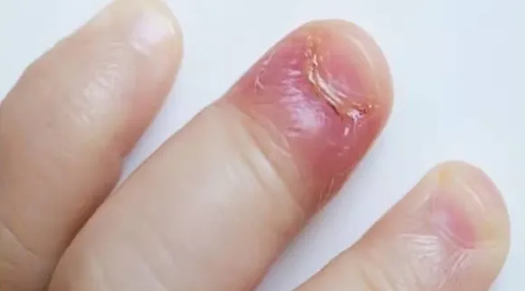 Nail fungus