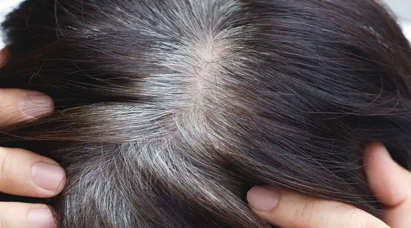 Greyhair issue
