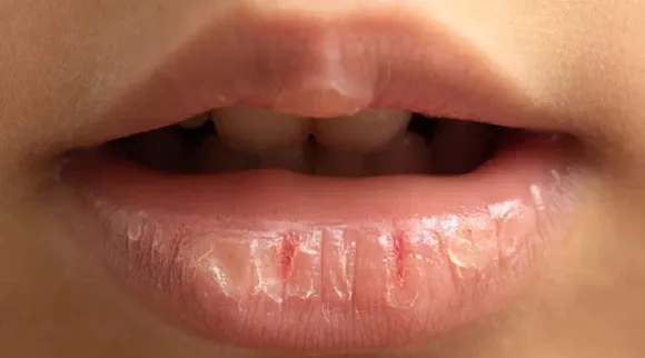 Lip crack