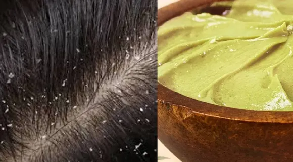 Dandruff