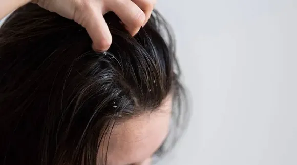 Dandruff