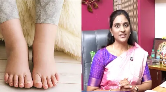 கால் வீக்கம்