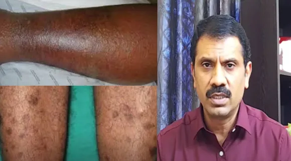 TOP REASONS FOR BLACKENING OF LEGS |TREATMENT