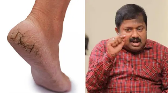 Cracked Heels