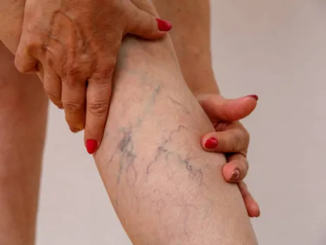 varicose veins