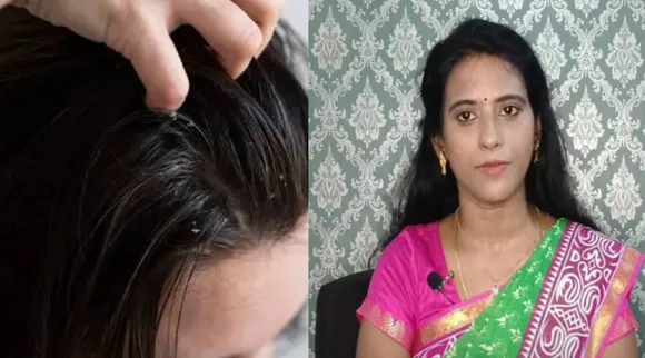 dandruff 