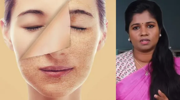 melasma