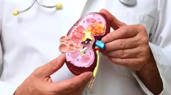 kidney-stone