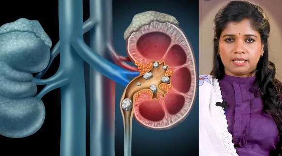 kidney-stone