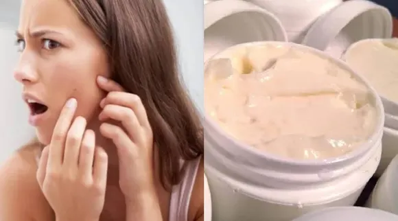 Pimple cream