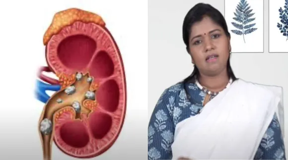 பித்தப்பை கல்