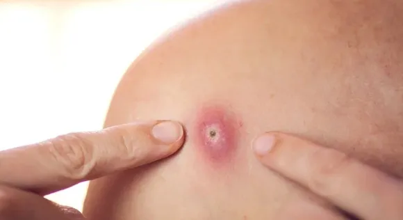 Skin boils