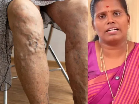 varicose veins