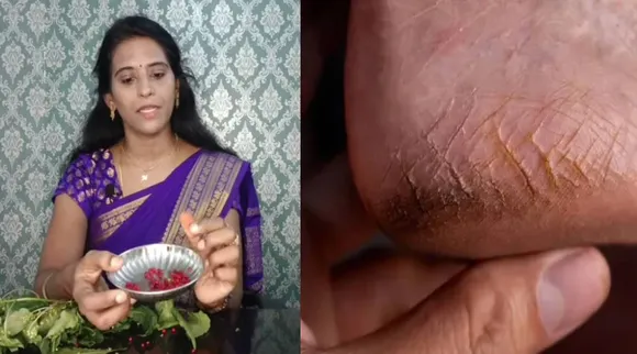பாத வெடிப்பு 