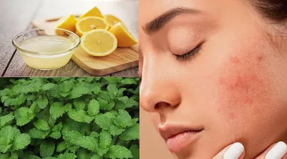 Pimple remedy