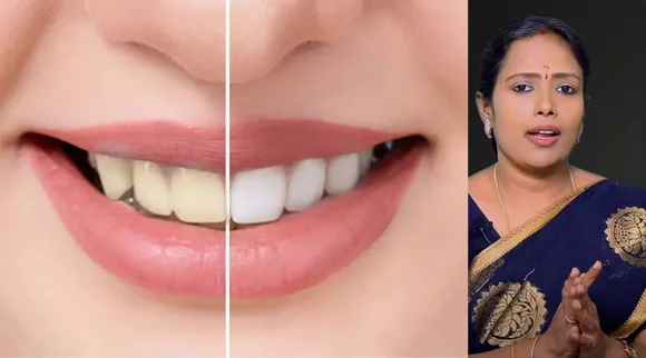 Teeth Whitening Tips
