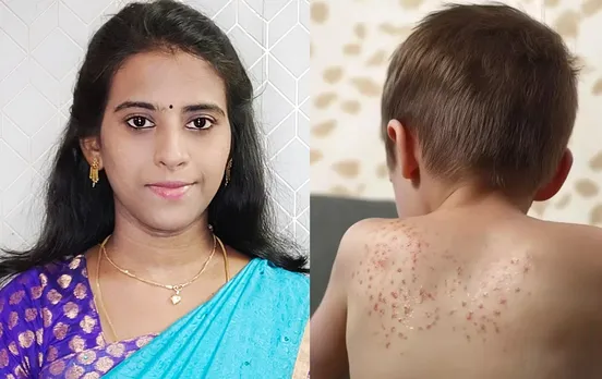 summer skin problems natural remedies