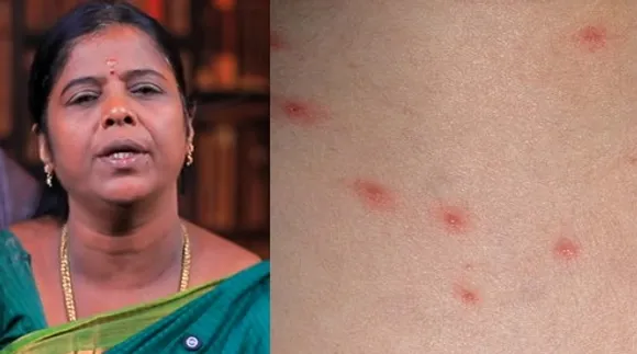 Chickenpox home remedy