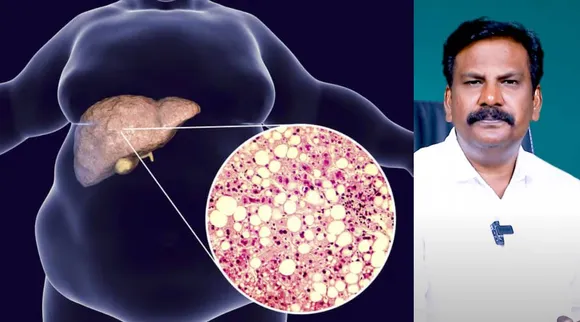 Fat that sticks to the liver.