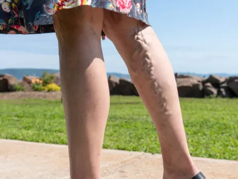 varicose veins
