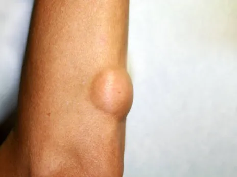 Lipoma