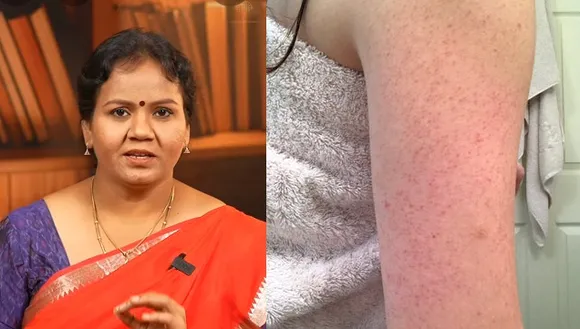 Dark spots on skin Natural remedies