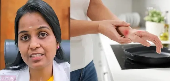 Got Burned While Cooking