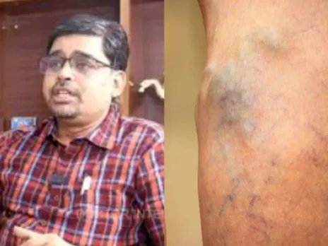 varicose veins