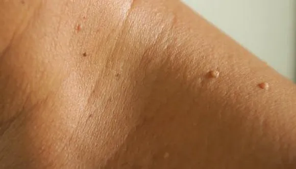 Skin tags moles causes treatment