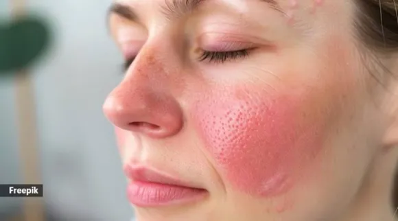 rosacea