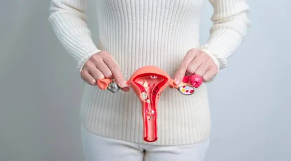 PCOS 