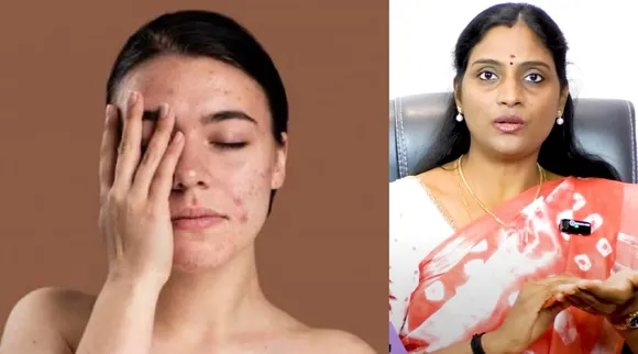pigmentation