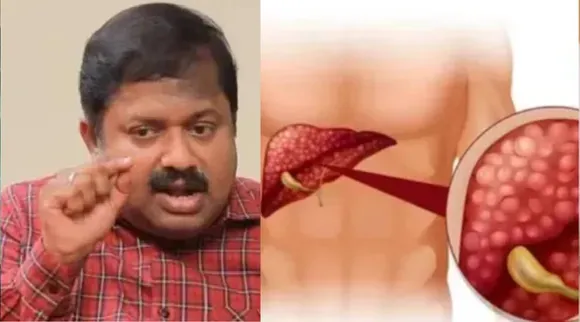 Fatty liver remedy