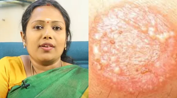 rajalakshmi ringworm