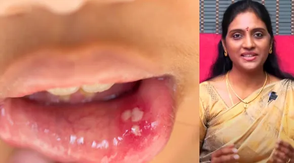 canker sores will