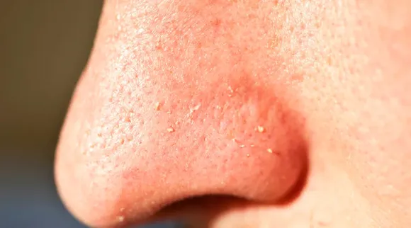 whiteheads