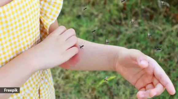 mosquito bites