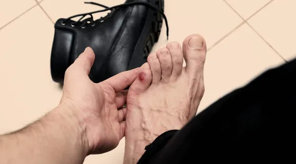 home-remedies-for-shoe-bites-in-tamil