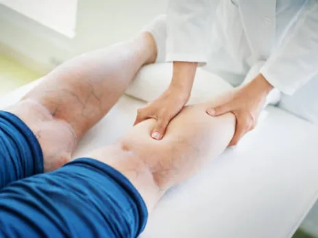 varicose veins