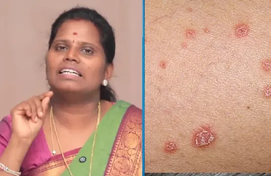 Psoriasis natural Home remedies